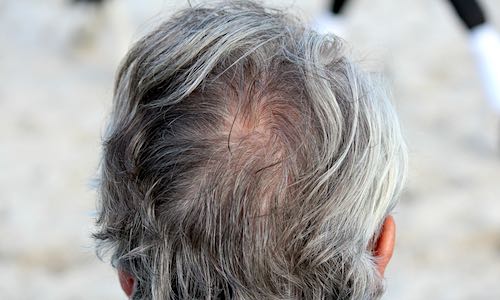 hairloss cure experimental dpdmp gray head of hair at crown