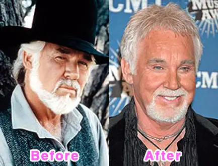 kenny rogers before and after plastic surgery buzzfeed