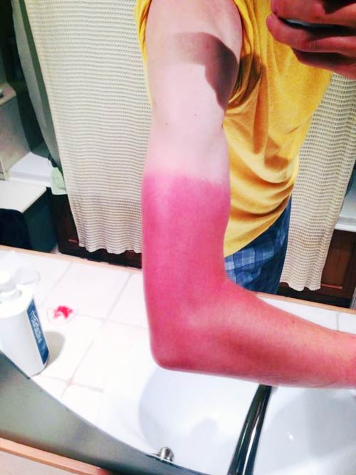 pleated jeans sunburn on arm with yellow shirt